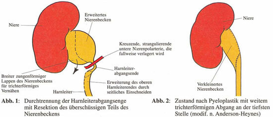 UniversitätsKlinikum Heidelberg: Harnaufstau, Erweiterung des Nierenhohlsystems und des ...