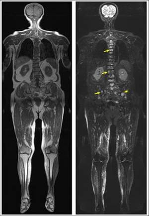 Fett- und wassergewichtete Ganzkörper-MRT bei einem Patienten mit Multiplem Myelom. Deutlich lassen sich multiple Myelomherde abgrenzen (Pfeile).