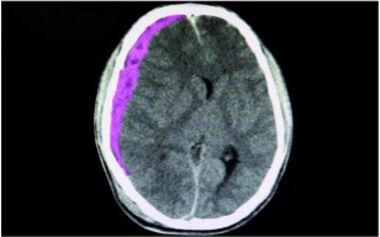 Einblutung unter die harte Hirnhaut (markiertes Areal) mit Verschiebung der Hirnstrukturen.