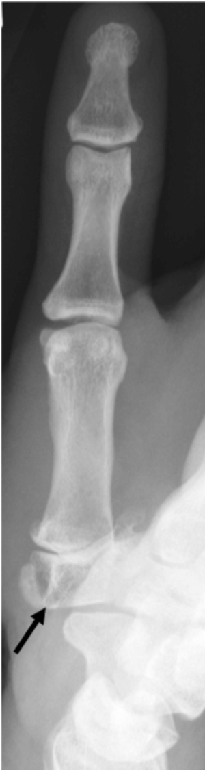 Röntgenbild des Daumens