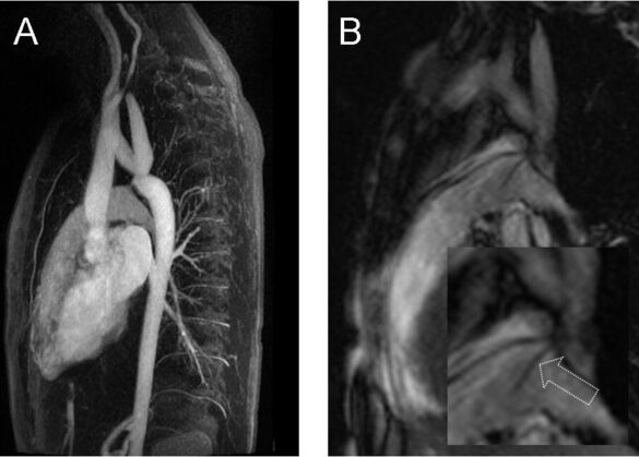 Abbildung einer Patientin mit echokardiographisch diagnostizierter Aortenisthmusstenose.