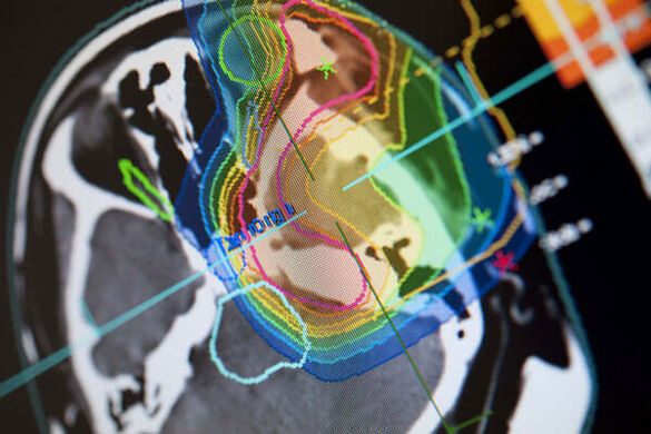 Three-dimensional computer simulation of the tumor area