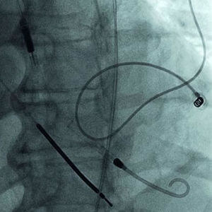 Abiomed Impella® (A) Abiomed Impella® (A)