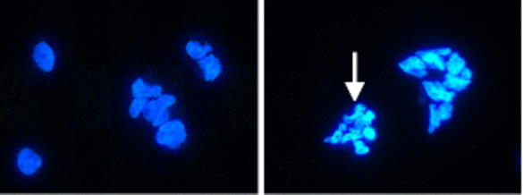 Nachweis von Apoptose in Kaliumkanal-exprimierenden Kulturzellen. Links: normale Kontrollzellen. Rechts: Die Zellen weisen in der Hoechst-Färbung charakteristische Kern-Fluoreszenz und Fragmentierung (Pfeil) als Zeichen für Apoptose auf.
