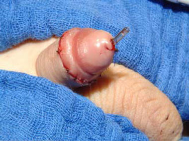 Abbildung: Hypospadie- Korrektur intraoperativ Abbildung: Hypospadie- Korrektur intraoperativ