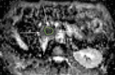 Diffusionsgewichtetes MRT-Bild