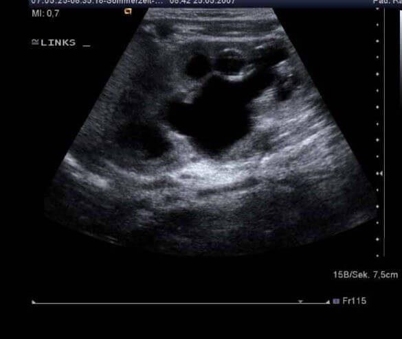 Abbildungen: Sonographischer Nachweis einer Nierenbeckenabgangsstenose mit deutlich dilatiertem Nierenbecken Abbildungen: Sonographischer Nachweis einer Nierenbeckenabgangsstenose mit deutlich dilatiertem Nierenbecken
