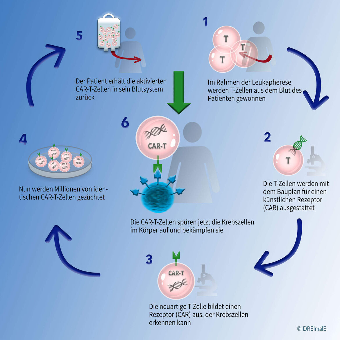 Grafik zum Ablauf der CAR-T-Zelltherapie