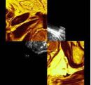 BiopSee® MRT-navigierte stereotaktische Prostatastanzbiopsie BiopSee® MRT-navigierte stereotaktische Prostatastanzbiopsie
