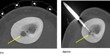 Die Abbildung 9a  zeigt ein ca. 5 mm messendes Osteoidosteom->  im Oberschenkelknochen eines 19-jährigen Patienten. In Abbildung 9b ist die Spitze einer Elektrode in dem Tumor platziert worden. Die Spitze wird erhitzt,  der Tumor damit lokal abgetötet.