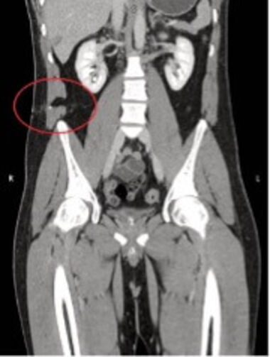 Nahezu horizontal verlaufender Stichkanal in den rechtseitigen Bauch oberhalb des Beckenkamms.