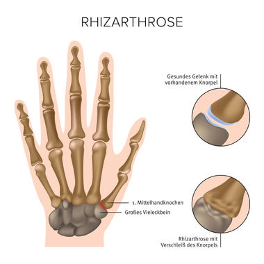 Darstellung der Rhizarthrose