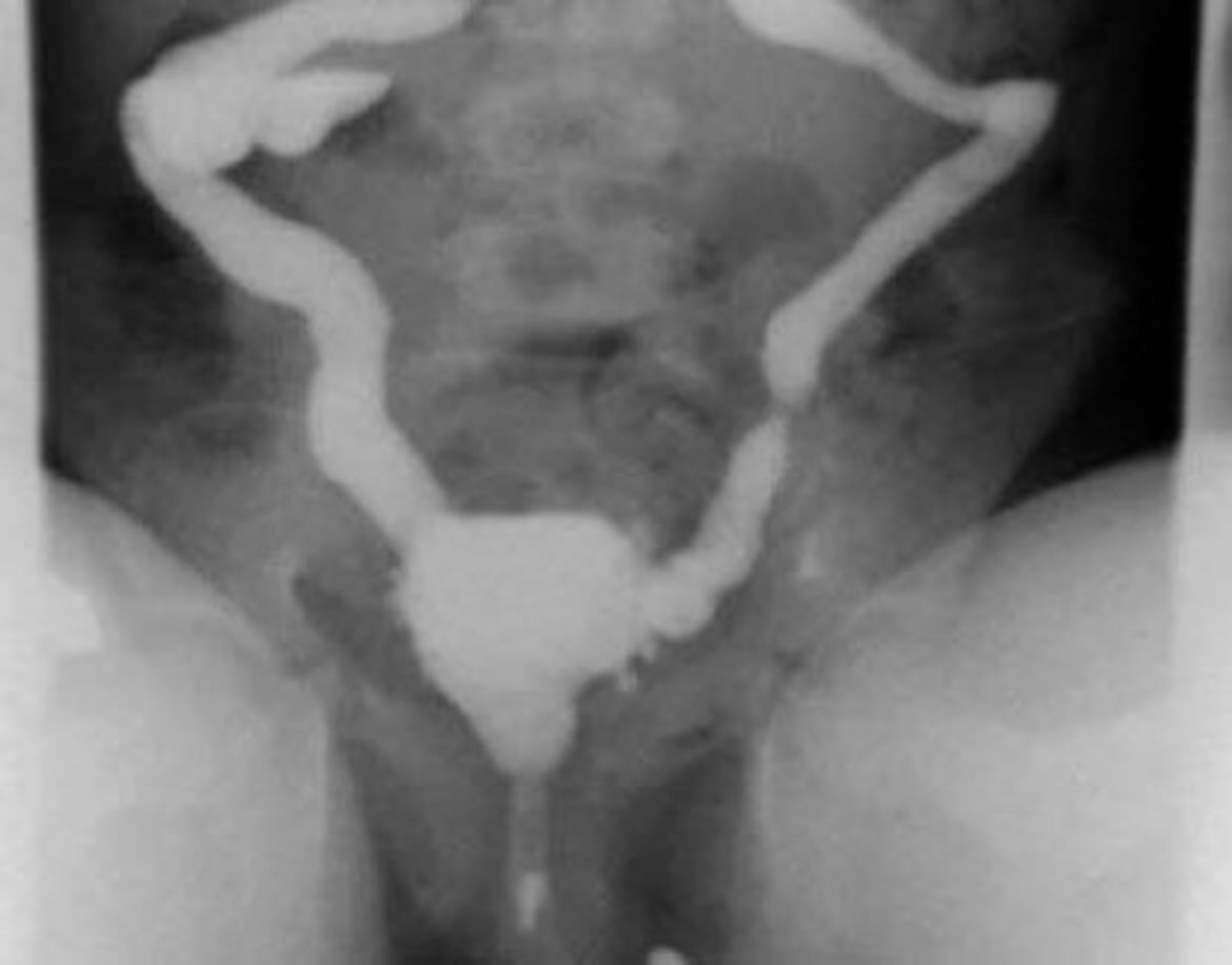 Abbildung: Röntgenologische Darstellung einer neurogenen Blase mit beidseitigem vesicorenalem Reflux Abbildung: Röntgenologische Darstellung einer neurogenen Blase mit beidseitigem vesicorenalem Reflux