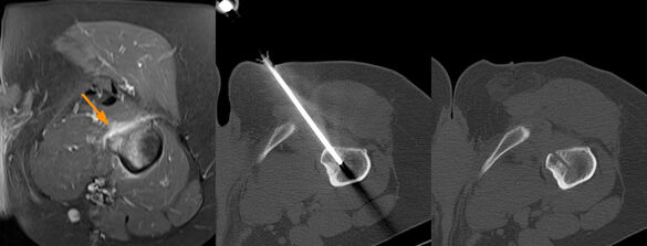 Abbildung 10: Diagnostische Knochenbiopsie bei einer im MRT des Beckens (links) Kontrastmittel aufnehmenden, den Knochen destruierenden Läsion. Knochenbiopsie CT-gesteuert über einen kleinen Hautschnitt in Lokalanästhesie (Mitte) und Entnahme eines zyl
