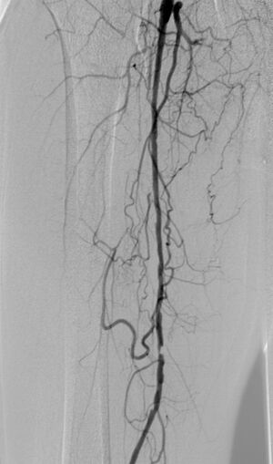 Abbildung 5: Periphere arterielle Verschlusskrankheit(PAVK) - hochgradige kurzstreckige Stenose der rechten Arteria femoralis superficialis in der konventionellen Angiographie .