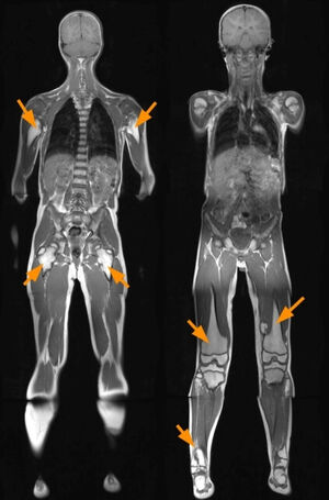 Abbildung 2: Patient mit Exostosenkrankheit und multiplen Exostosen der Extremitäten (Pfeile) in einer Ganzkörper-MRT Untersuchung ohne Einsatz von Röntgenstrahlen