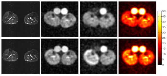 Abbildung 4: Links: Nach Provokation durch Kühlung des rechten Unterschenkels ist in der herkömmlichen 1H MRT (links) kein Unterschied sichtbar. Die 23Natrium-Magnetresonanztomographie zeigt den pathologisch erhöhten Gehalt an Natrium in der Muskelzell