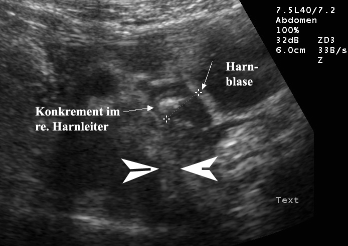 Ultraschall blase Sonographie der