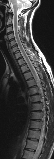 MRT HWS & BWS T2-gewichtet sagittal