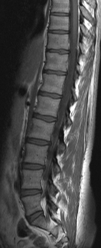 Mrt Lws : Moderne Diagnosemoglichkeiten Im Detail Prospine Diagnostik