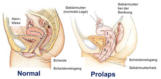 Gebärmutter wie krank entfernung lange Polypen Gebärmutter