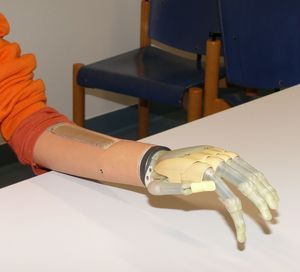 Prosthetic hand i-LIMB from the Scottish company Touch Bionics.Source: Orthopedic University Hospital in Heidelberg